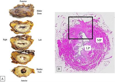 Bladder Cancer Sample Handling and Reporting: Pathologist's Point of View